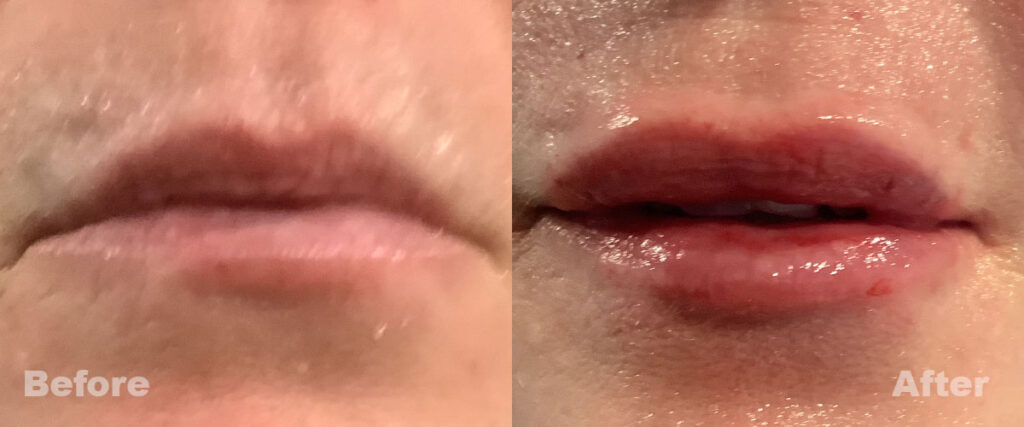 Before and After of Lip Injections Slide 4