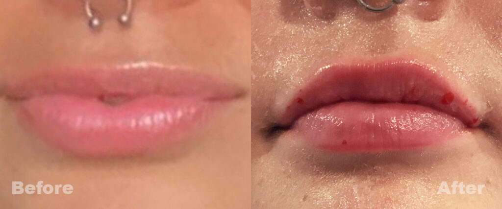 Before and After of Lip Injections Slide 3