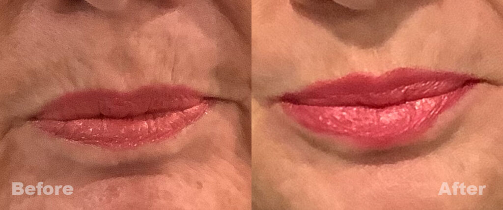 Before and After of Lip Injections Slide 2