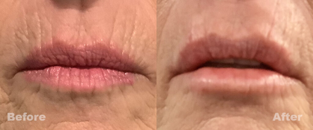 Before and After of Lip Injections Slide 1
